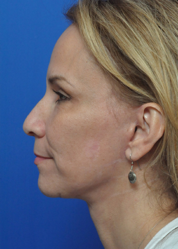 Neck Lift Before and After Pictures Jacksonville, FL