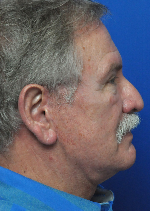 Neck Lift Before and After Pictures Jacksonville, FL