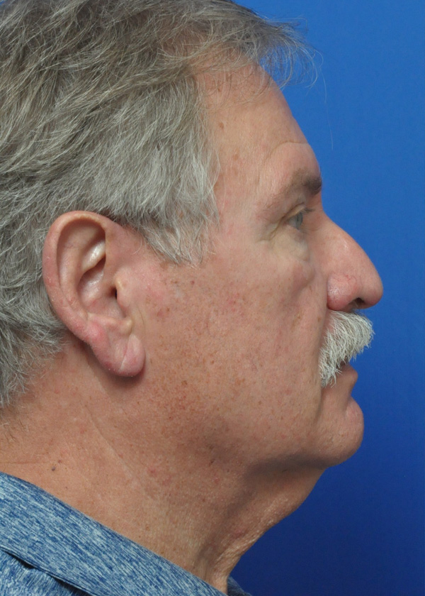 Neck Lift Before and After Pictures Jacksonville, FL