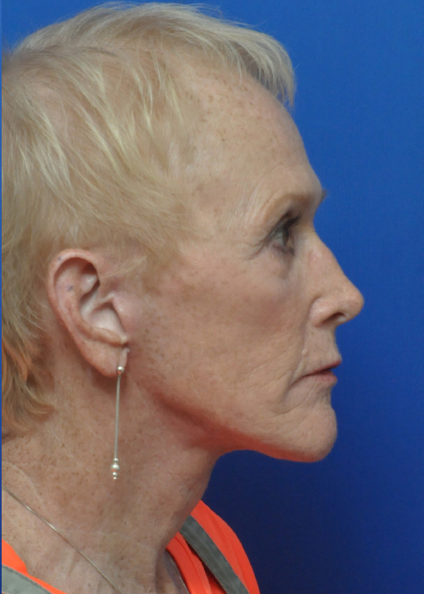 Neck Lift Before and After Pictures Jacksonville, FL