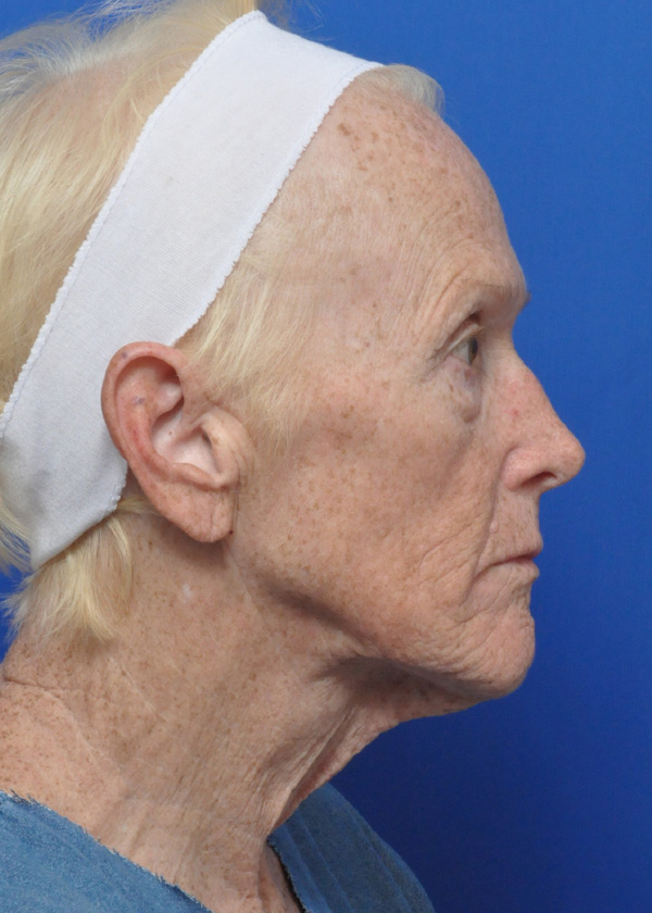 Neck Lift Before and After Pictures Jacksonville, FL