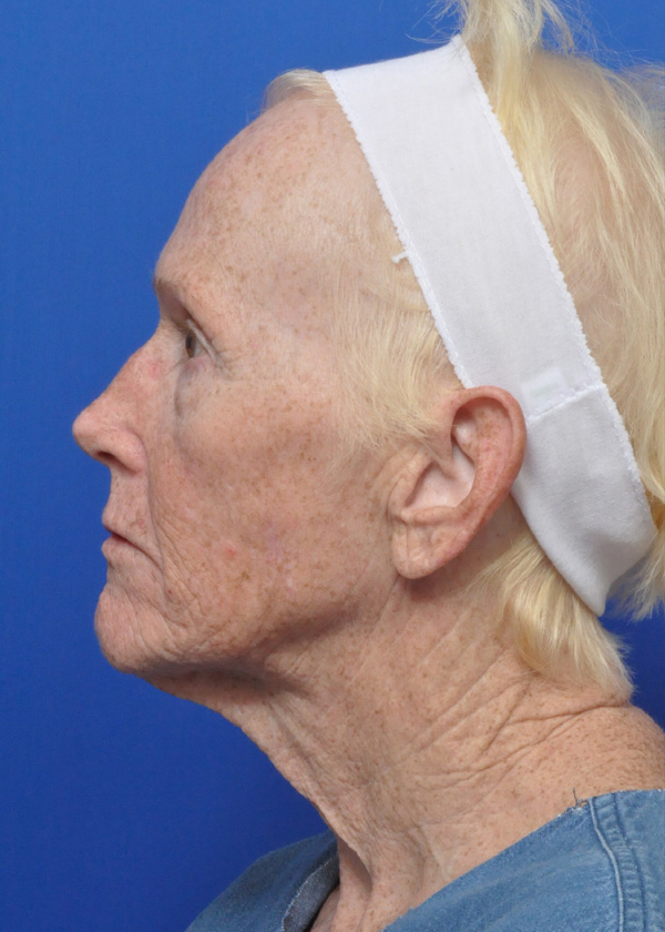 Neck Lift Before and After Pictures Jacksonville, FL