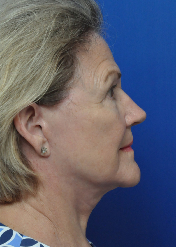 Neck Lift Before and After Pictures Jacksonville, FL