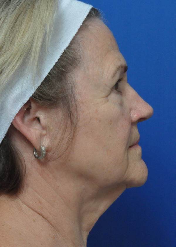 Neck Lift Before and After Pictures Jacksonville, FL