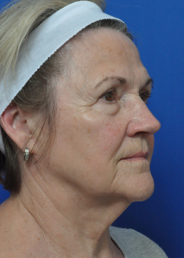 Neck Lift Before and After Pictures Jacksonville, FL