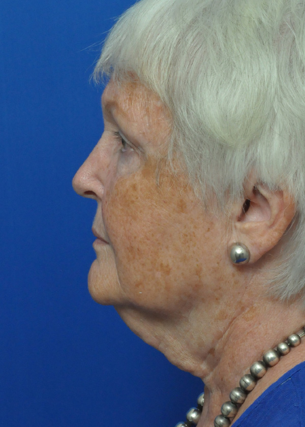 Neck Lift Before and After Pictures Jacksonville, FL