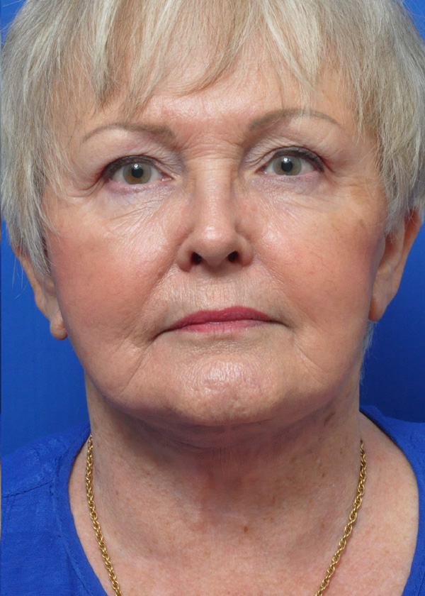 Neck Lift Before and After Pictures Jacksonville, FL