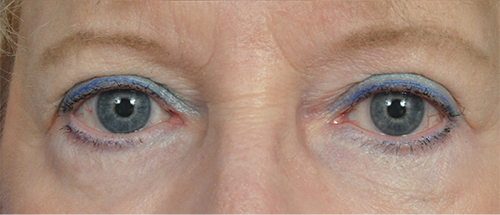 Brow Lift Before and After Pictures Jacksonville, FL