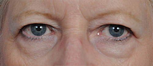 Brow Lift Before and After Pictures Jacksonville, FL