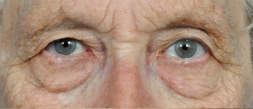 Brow Lift Before and After Pictures Jacksonville, FL