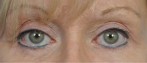 Brow Lift Before and After Pictures Jacksonville, FL