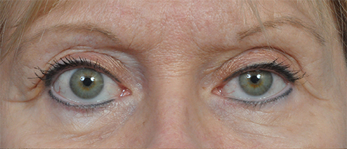 Brow Lift Before and After Pictures Jacksonville, FL