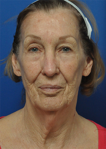 Dermabrasion Before and After Pictures Jacksonville, FL