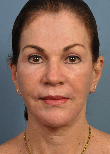 Dermabrasion Before and After Pictures Jacksonville, FL