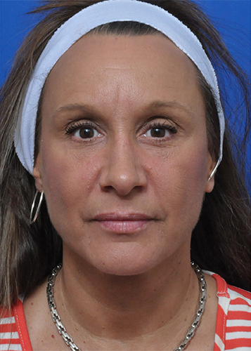Chemical Peel Before and After Pictures Jacksonville, FL