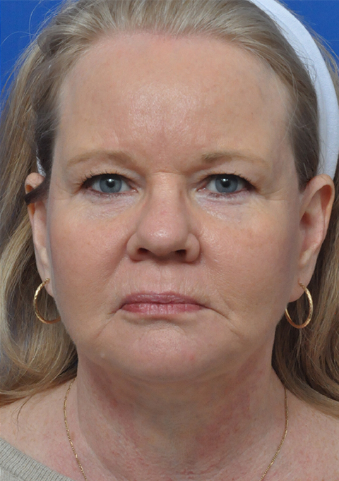 Chemical Peel Before and After Pictures Jacksonville, FL