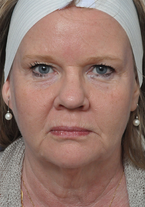 Chemical Peel Before and After Pictures Jacksonville, FL