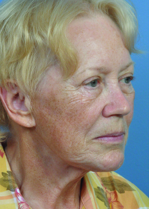 Dermabrasion Before and After Pictures Jacksonville, FL