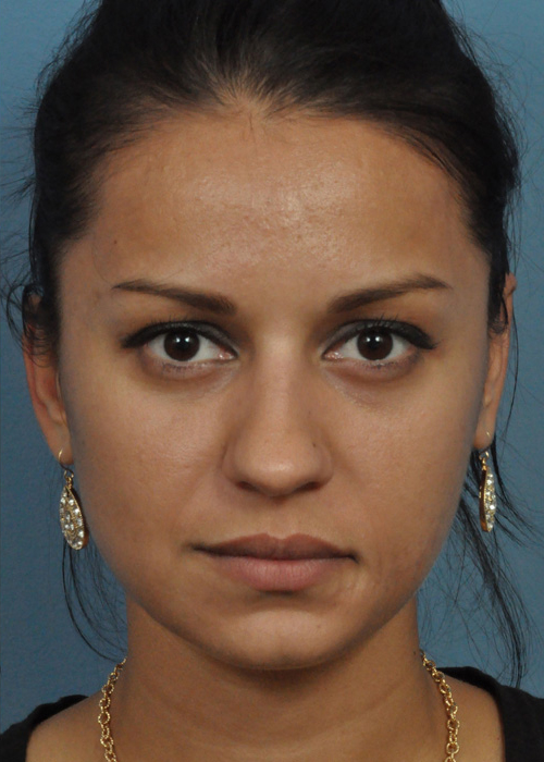 Dermabrasion Before and After Pictures Jacksonville, FL