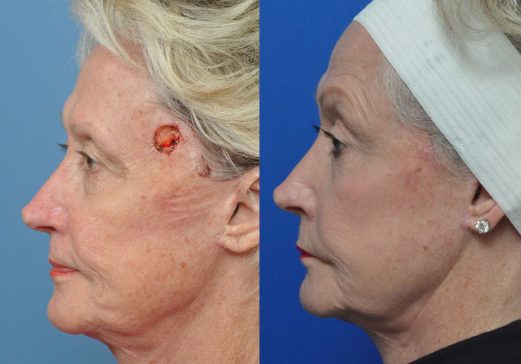 Facial Reconstruction Before and After Pictures Jacksonville, FL