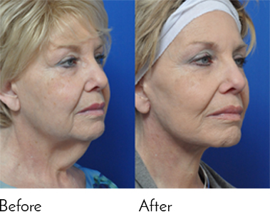 face slimming surgery before and after jacksonville fl