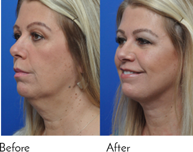 face slimming surgery before and after jacksonville fl