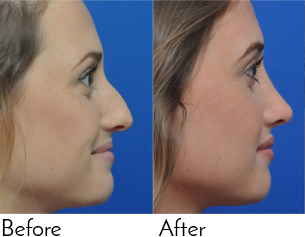 Rhinoplasty Before and After Pictures Jacksonville, FL