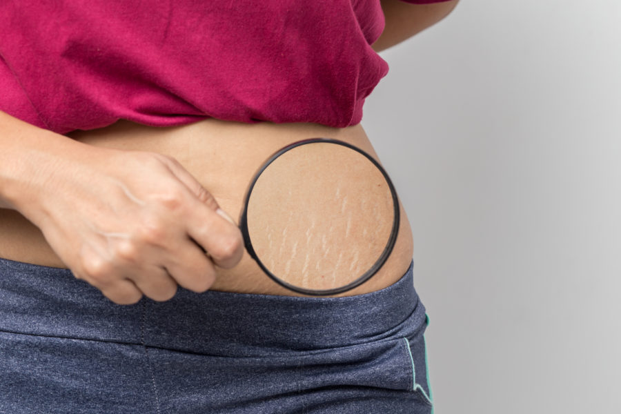 Stretch Marks in Jacksonville FL