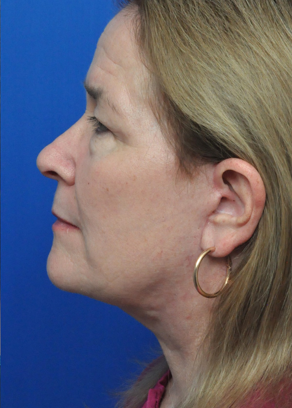 Neck Lift Before and After Pictures Jacksonville, FL