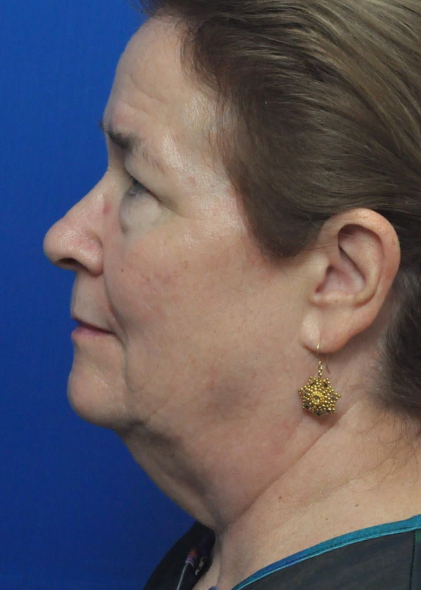 Neck Lift Before and After Pictures Jacksonville, FL