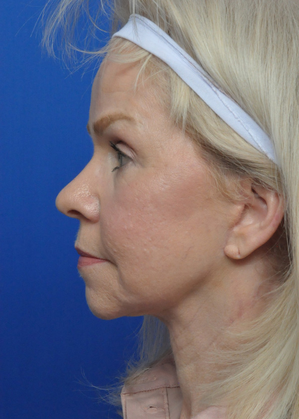 Neck Lift Before and After Pictures Jacksonville, FL