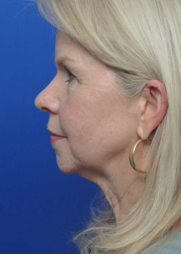 Neck Lift Before and After Pictures Jacksonville, FL