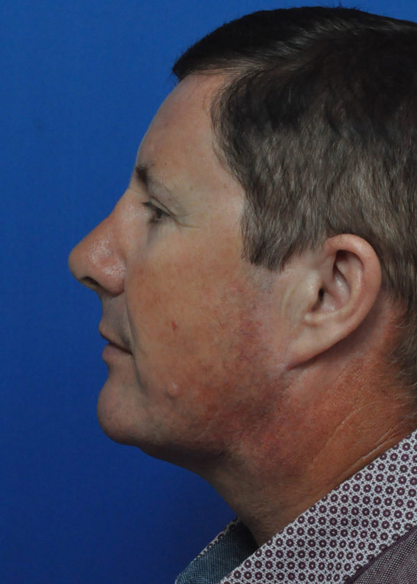 Neck Lift Before and After Pictures Jacksonville, FL