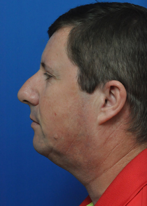 Neck Lift Before and After Pictures Jacksonville, FL