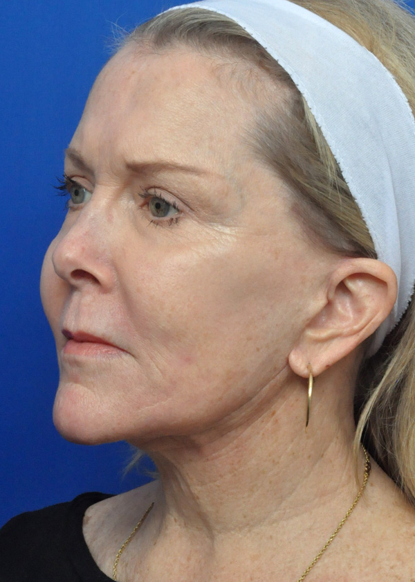 Neck Lift Before and After Pictures Jacksonville, FL