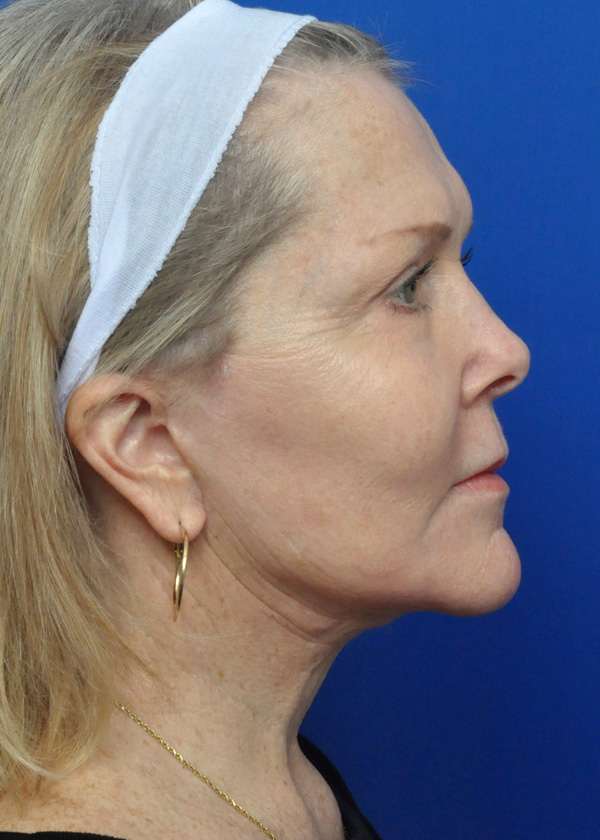 Neck Lift Before and After Pictures Jacksonville, FL