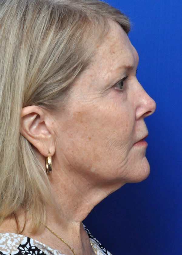 Neck Lift Before and After Pictures Jacksonville, FL