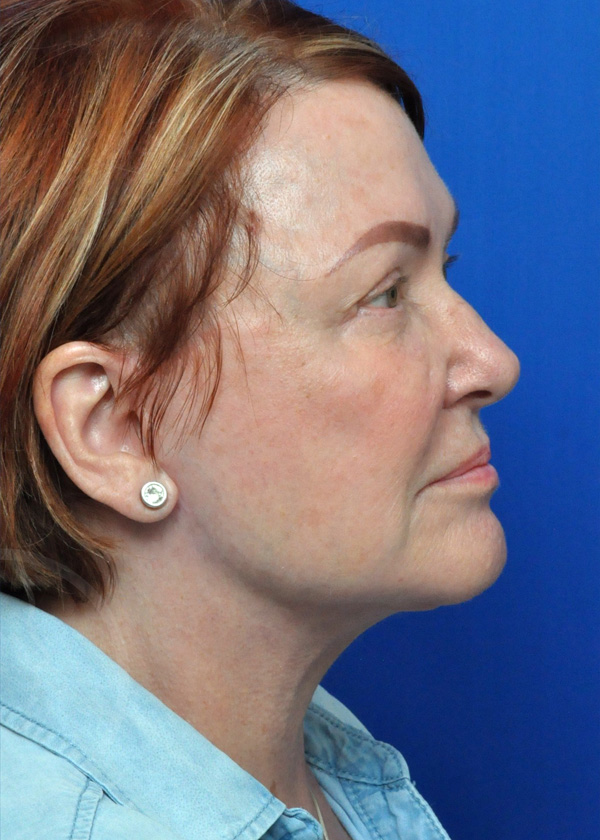 Neck Lift Before and After Pictures Jacksonville, FL