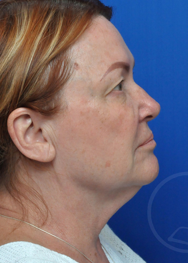 Neck Lift Before and After Pictures Jacksonville, FL