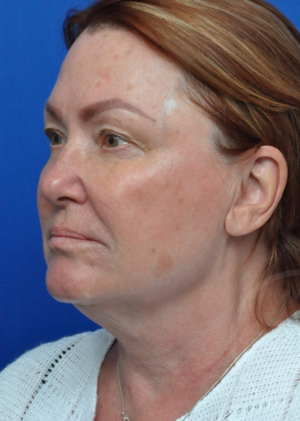 Neck Lift Before and After Pictures Jacksonville, FL