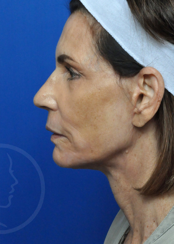 Neck Lift Before and After Pictures Jacksonville, FL