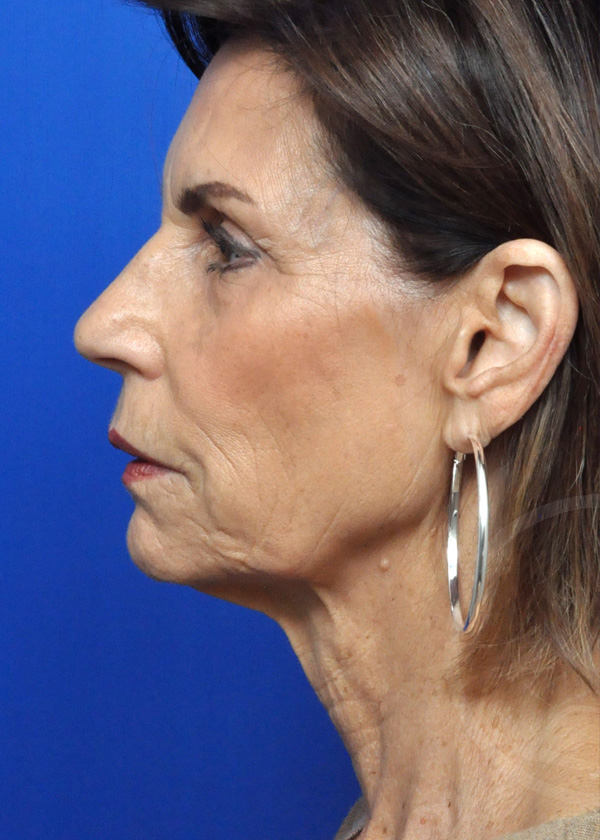 Neck Lift Before and After Pictures Jacksonville, FL