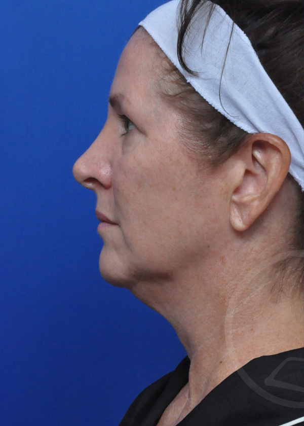 Neck Lift Before and After Pictures Jacksonville, FL