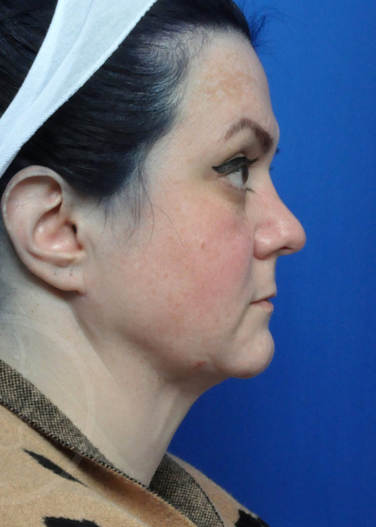 Neck Liposuction Before and After Pictures in Jacksonville, FL