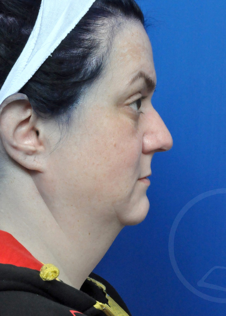 Neck Liposuction Before and After Pictures in Jacksonville, FL