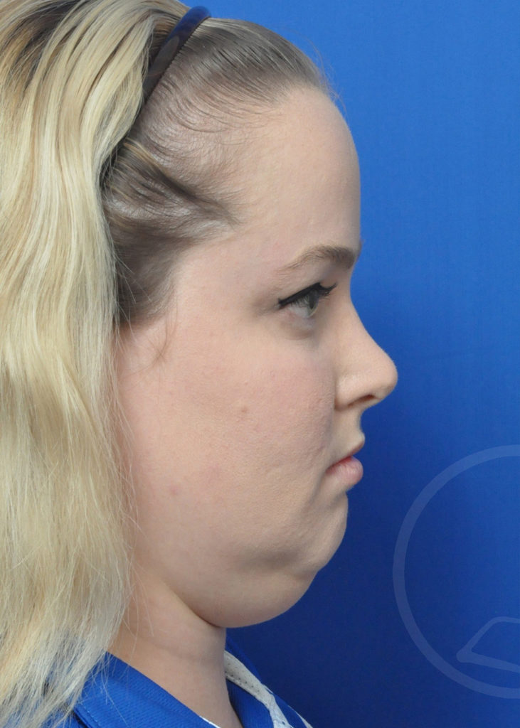 Neck Liposuction Before and After Pictures in Jacksonville, FL