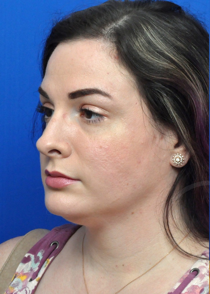 Neck Liposuction Before and After Pictures in Jacksonville, FL