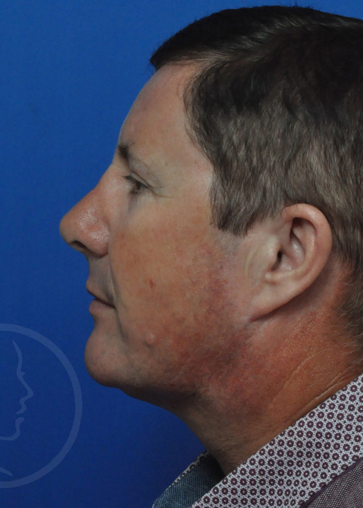 Neck Liposuction Before and After Pictures in Jacksonville, FL