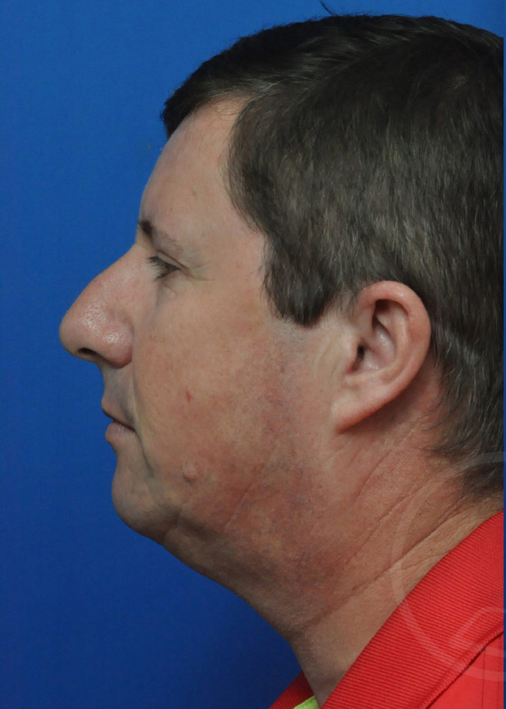 Neck Liposuction Before and After Pictures in Jacksonville, FL