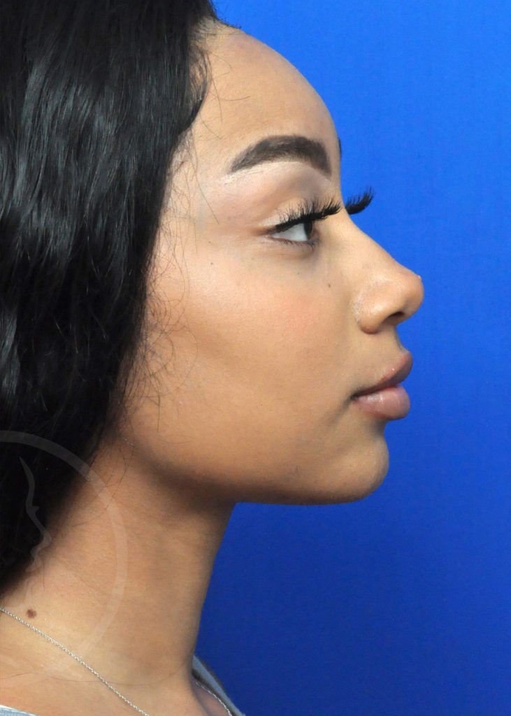 Neck Liposuction Before and After Pictures in Jacksonville, FL